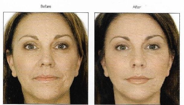 dermal fillers