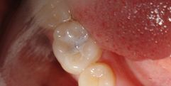 Fissure Sealants