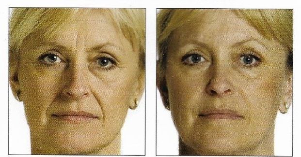 dermal fillers